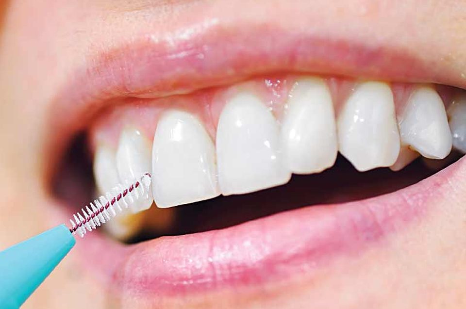 scovolino-denti-parodontite-dentista-a-varese